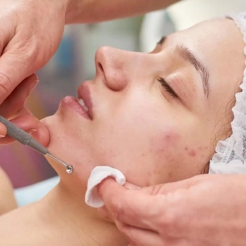 Acne Facial treatment